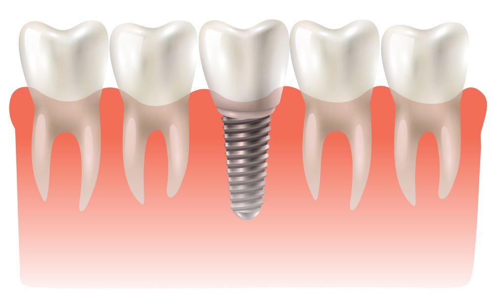 Aligners & Braces